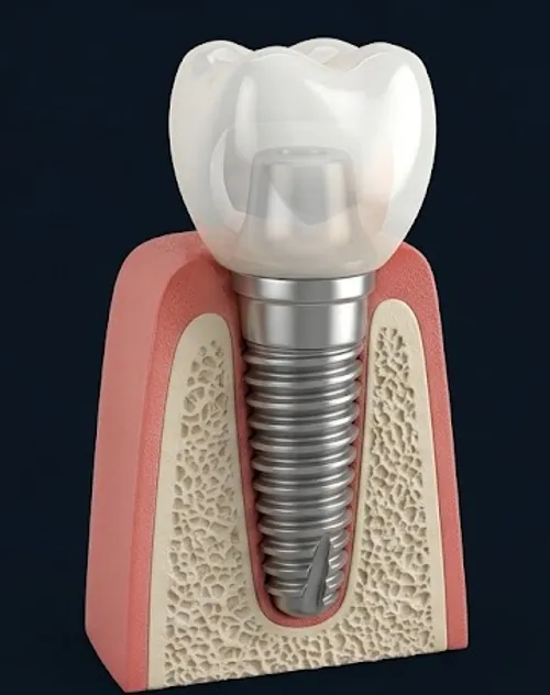 Ilustração anatômica de implante dentário de titânio osseointegrado na mandíbula com coroa cerâmica sobreposta