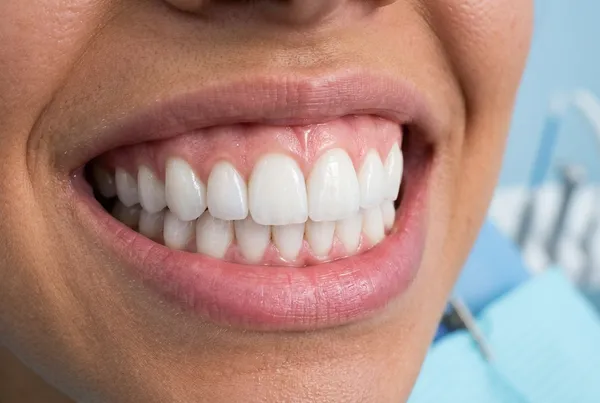 Serviço odontológico: Estética Dental e Clareamento - Dr. Luciano Freire em Passos MG
