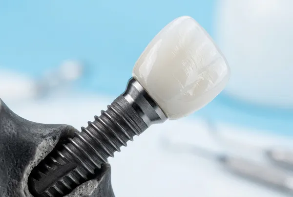 Serviço odontológico: Implantes Dentários - Dr. Luciano Freire em Passos MG